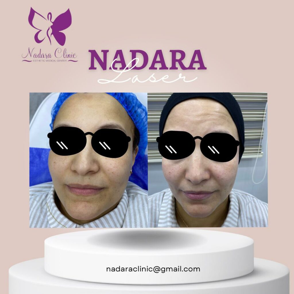 نتيجة جلسة تنظيف عميق للبشرة قبل وبعد